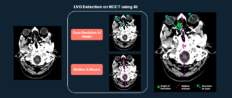 AI-Based Gaze Deviation Detection to Aid LVO Diagnosis in NCCT